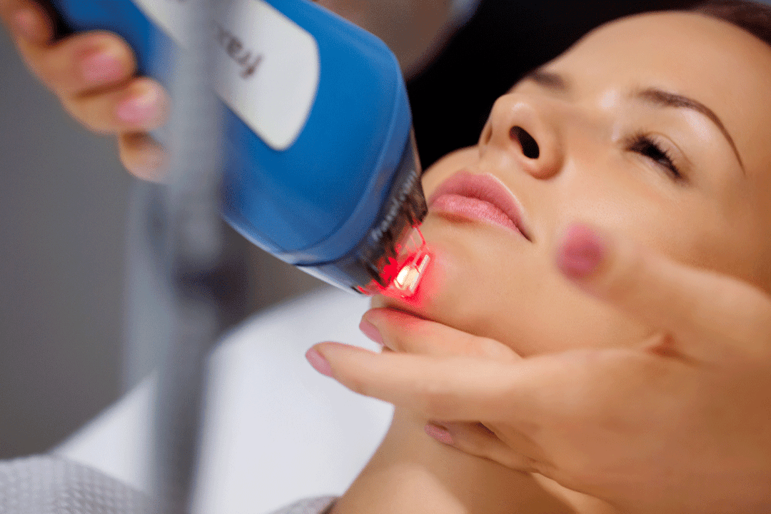 ласерско подмладување на кожата на лицето