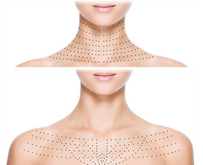 Обележување на кожата на вратот и деколтето за подмладување на биоревитализација