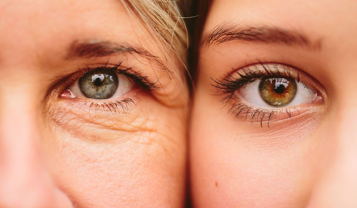 знаци на стареење околу очите
