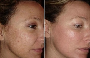 ласерско подмладување на кожата на лицето пред и по фотографиите
